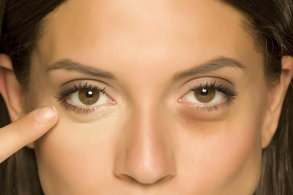 Bright-Eyed and Beautiful: Salon Treatments to Fix Baggy Eyes